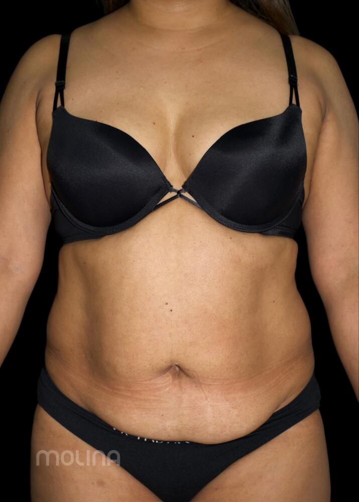 Tummy Tuck Before & After Image