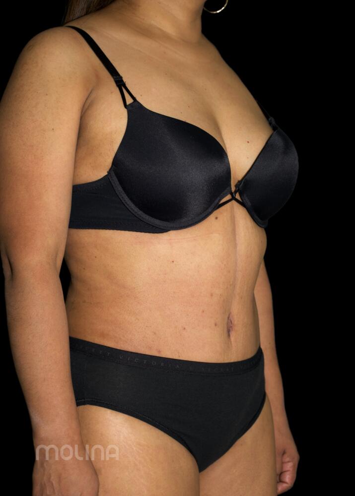 Tummy Tuck Before & After Image