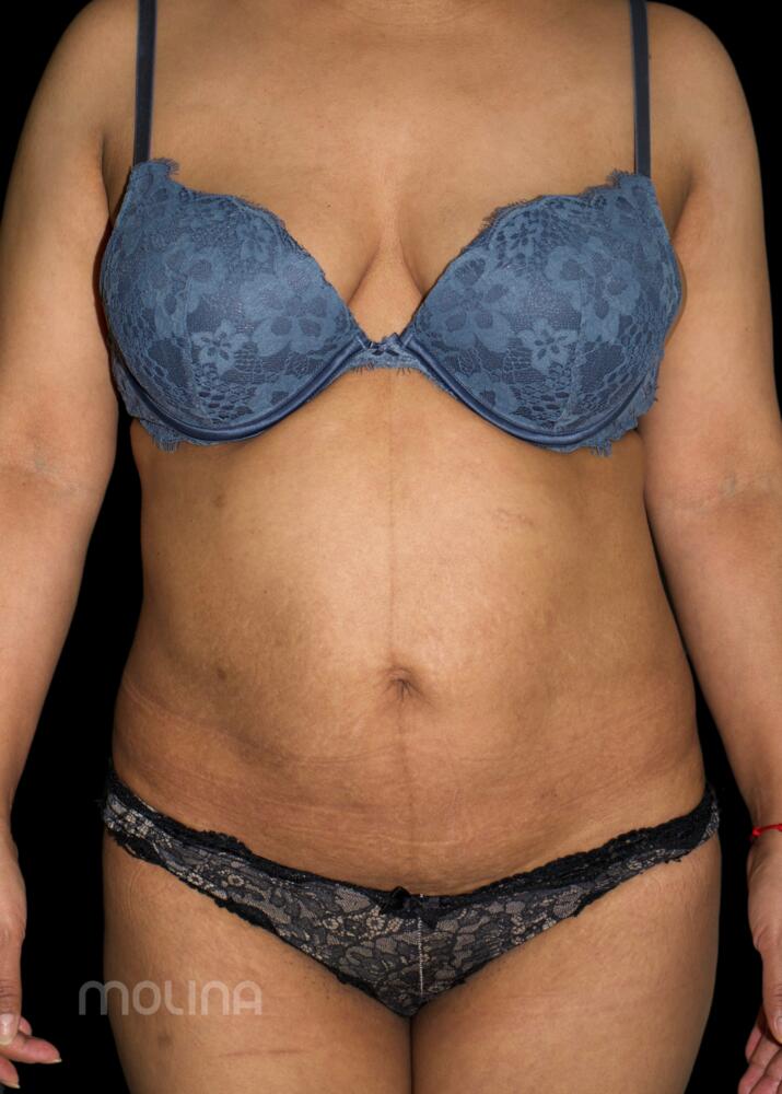 Tummy Tuck Before & After Image