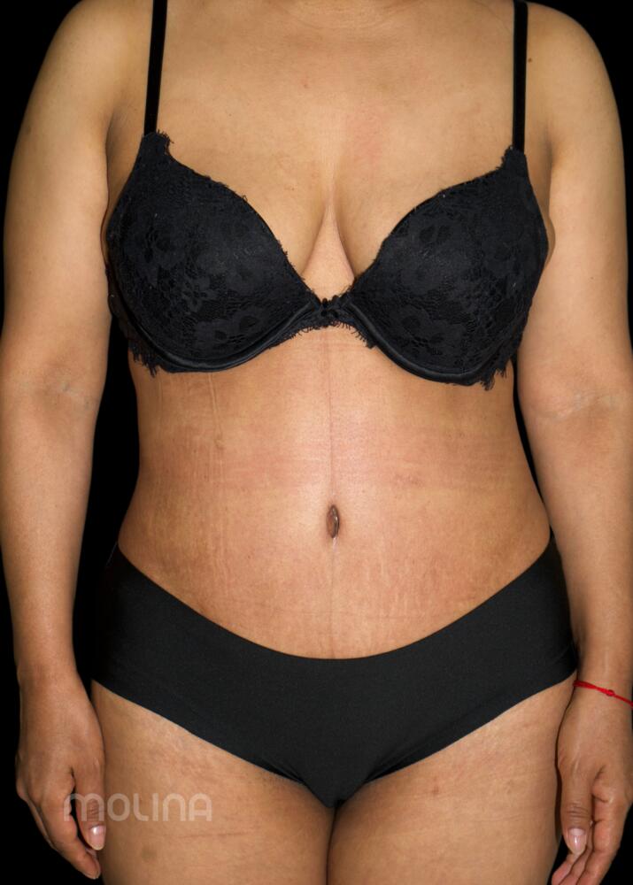 Tummy Tuck Before & After Image