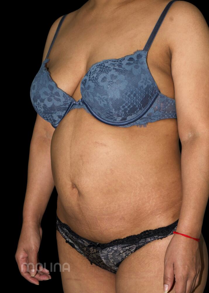 Tummy Tuck Before & After Image