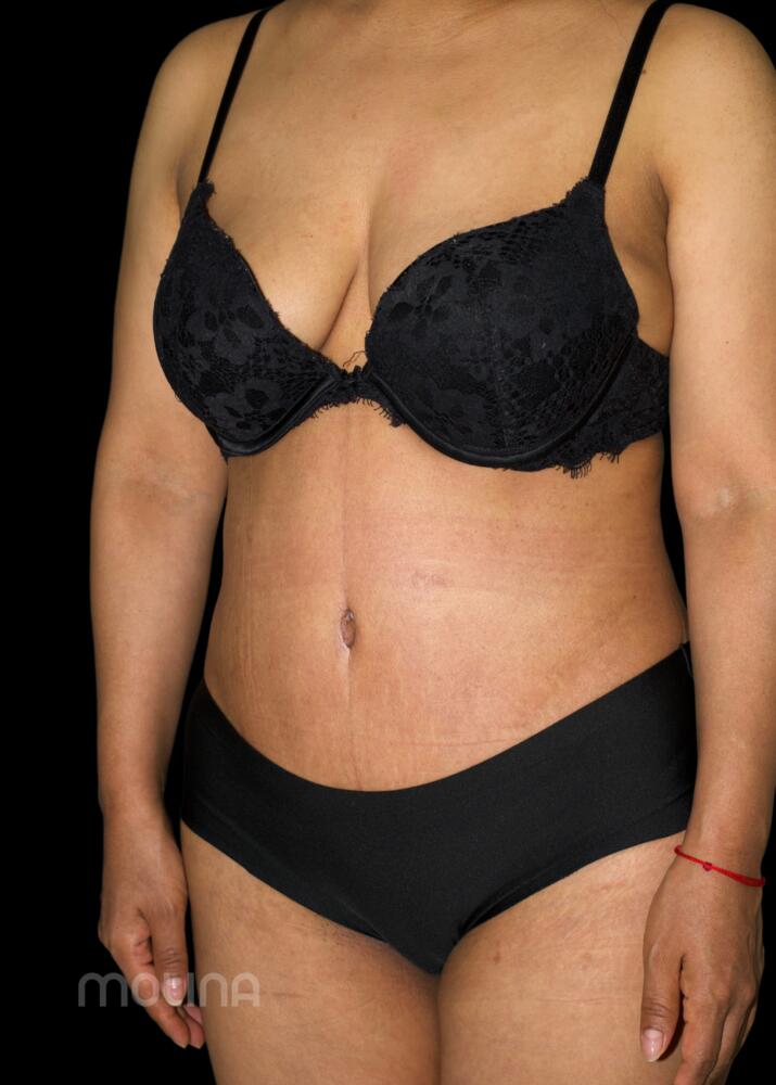 Tummy Tuck Before & After Image