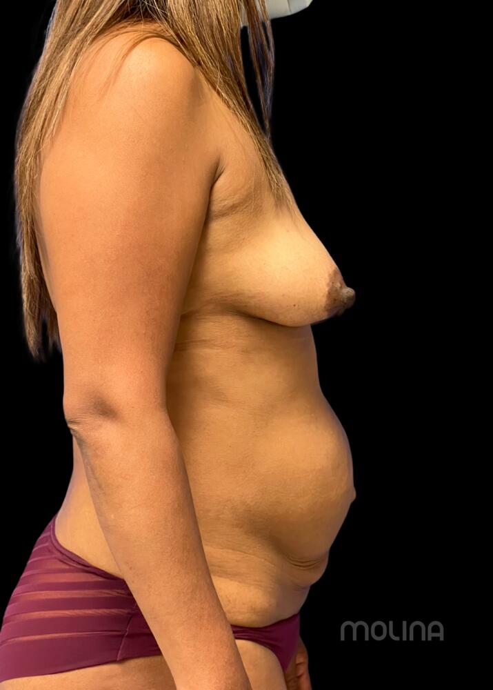 Breast Augmentation Before & After Image