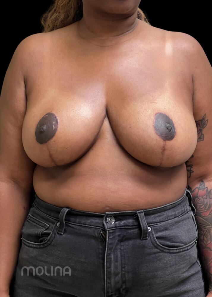 Breast Reduction Before & After Image