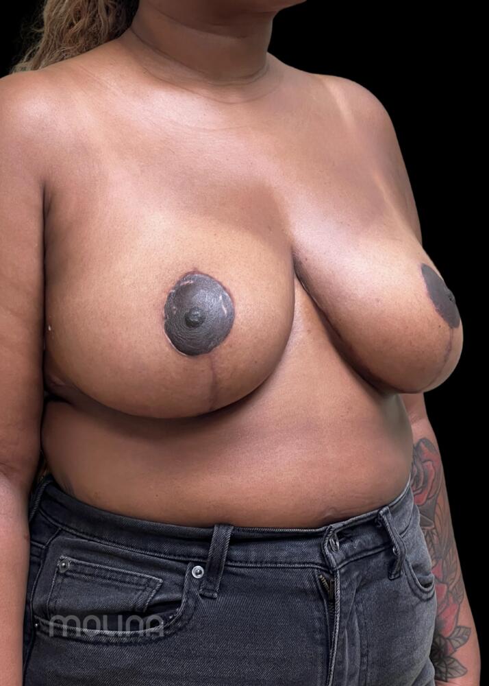 Breast Reduction Before & After Image