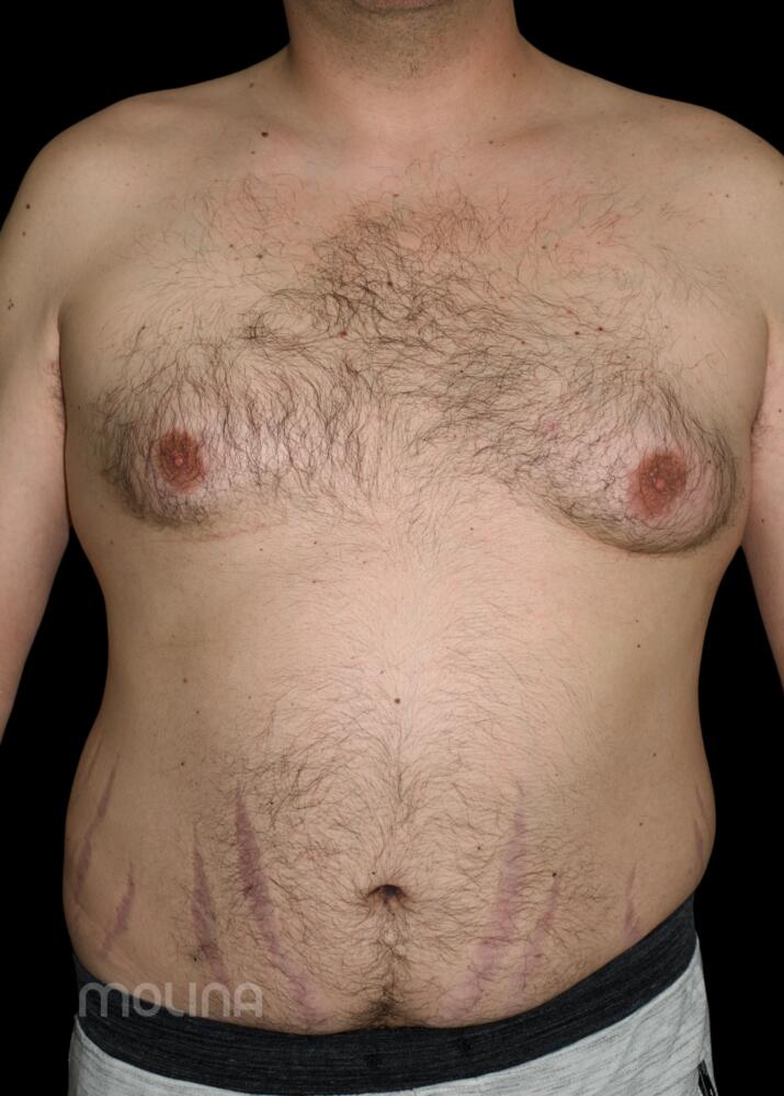 Gynecomastia Before & After Image