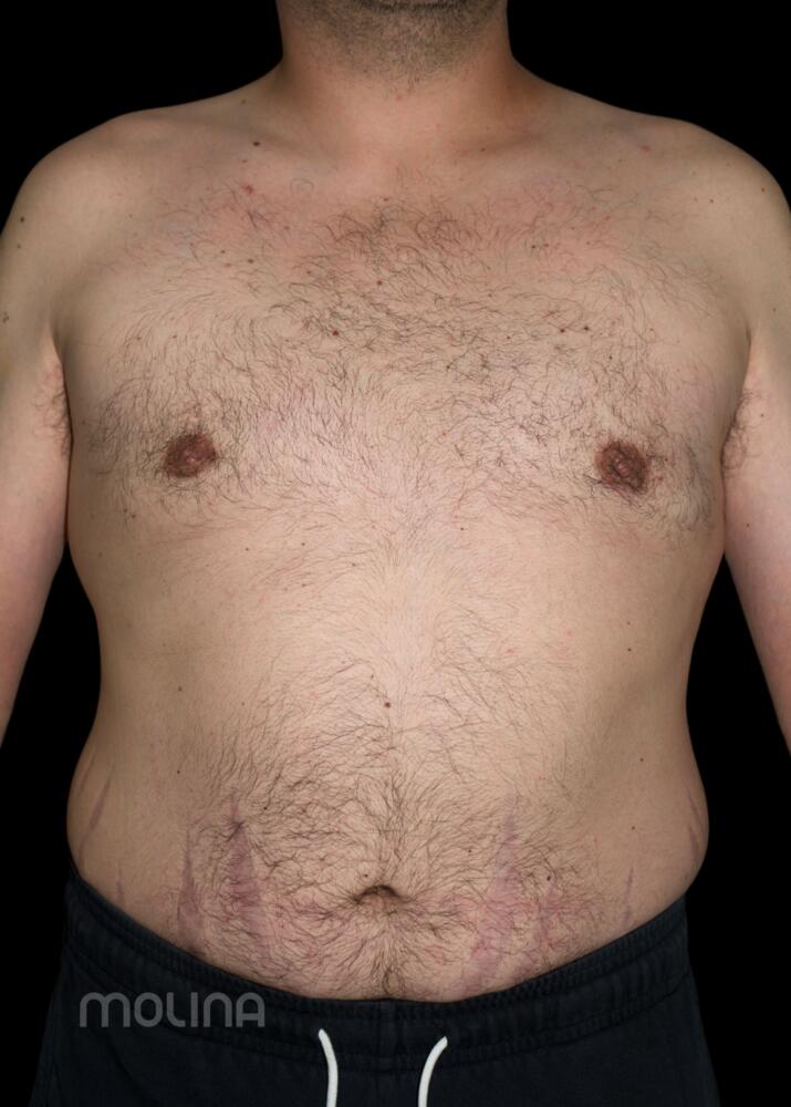 Gynecomastia Before & After Image