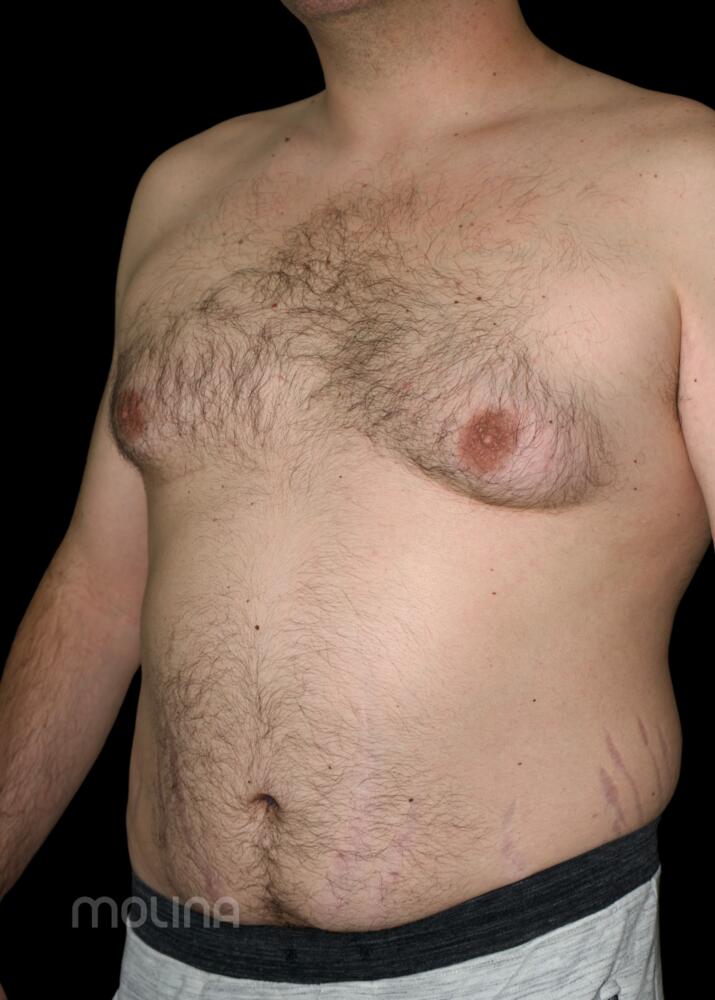 Gynecomastia Before & After Image