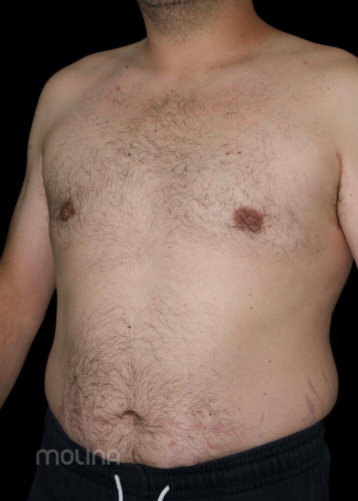 Gynecomastia Before & After Image