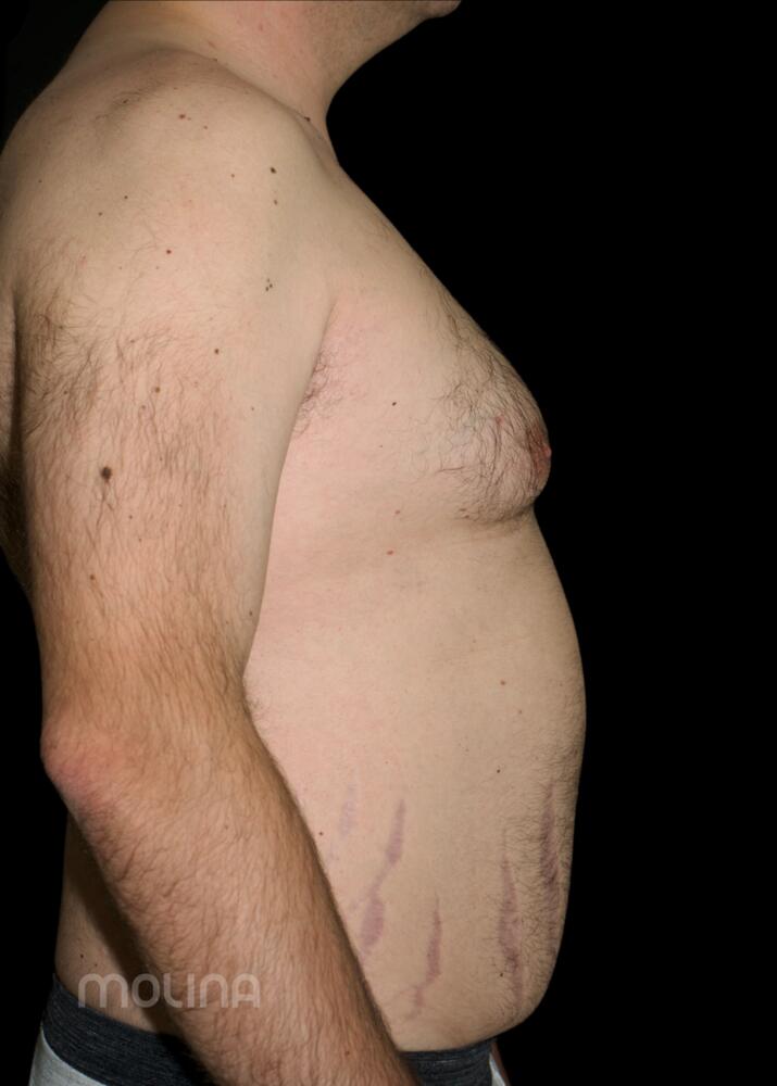 Gynecomastia Before & After Image